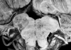 Recent infarct, dorsal medulla